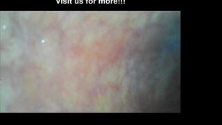 Hotkinkyjo XO speculum and deep anal abbys travel with endoscope camera